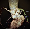 Angiography atherosclerotic changes vessels heart