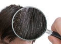 Examiming white dandruff flakes in hair with magnifying glass Royalty Free Stock Photo