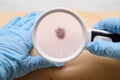 Examination of a mole on the patient`s body. The concept of studying moles to prevent the development of skin cancer or melanoma Royalty Free Stock Photo