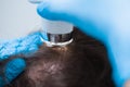 Examination of the patient`s scalp with a trichoscope. Trichoscopy of hair follicles