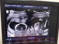 The results of medical ultrasonography of pregnant women seen on the monitor