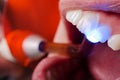 Examination of teeth vitality with UV lamp