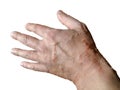 An example of a chemical burn on the hand skin from hogweeds