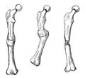 Examples of fused bones after a fracture.