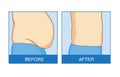 Before and after of excess abdominal fat to flat.