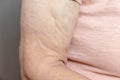 An excess loose skin on an arm of a senior elderly woman after extreme weight loss