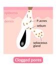 Sebum plugs causes clogged pores, which lead to acne. Skin care concept