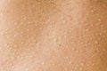 Excessive sweating on human back with freckles. Beads of sweat are forming on the back. Royalty Free Stock Photo