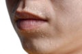 Excessive sweating or hyperhidrosis at face of Southeast Asian, Myanmar or Chinese adult young man