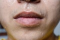 Excessive sweating or hyperhidrosis at face of Southeast Asian, Myanmar or Chinese adult young man