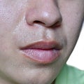 Excessive sweating or hyperhidrosis and oily skin at forehead of Asian, Myanmar or Chinese adult young man