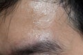 Excessive sweating or hyperhidrosis and oily skin at forehead of Asian, Myanmar or Chinese adult young man Royalty Free Stock Photo