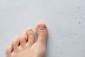 Exfoliation of nail on big toe, close-up in woman, girl. Toenail damage, fungus, trauma, big toe nail problems, nail detachment,