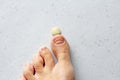 Exfoliation of nail on big toe, close-up in woman, girl. Toenail damage, fungus, trauma, big toe nail problems, nail detachment,