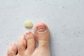 Exfoliation of nail on big toe, close-up in woman, girl. Toenail damage, fungus, trauma, big toe nail problems, nail detachment,