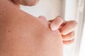 Exfoliation of the skin after sunburn. Man touching sun damaged peeling skin with a hand on a back. The skin peels off Royalty Free Stock Photo