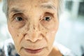 Exhausted asian senior woman suffering from insomnia,.chronic insomnia or allergies causing her sunken eye, dark circles, blear