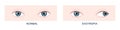 Exotropia. Horizontal strabismus before and after surgery. Eye misalignment, cross-eyed condition. Human eyes healthy Royalty Free Stock Photo