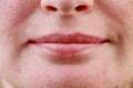 Expanded pores, acne, comedones, black spots. Lips close up. Problem skin girl