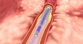 The expanded stent restores blood flow and will remain in the artery after the coronary stenting procedure Royalty Free Stock Photo