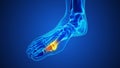 Painful gout inflammation on big toe joint