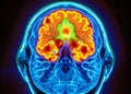 Exploring Brain Activity with Positron Emission Tomography PET Scan Visualizing Metabolic Hotspots