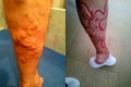 Extended Vein -Leg Disease - Preparing for Operation Royalty Free Stock Photo