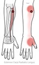 Extensor carpi radialis longus, showing elbow and thumb referred pain