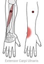 Extensor carpi ulnaris wrist pain