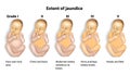 Extent of Jaundice icterus with Baby