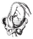 External cephalic version, vintage engraving