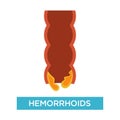 External and internal hemorrhoids with rectum structure illustration