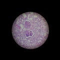 Extracapillary glomerulonephritis