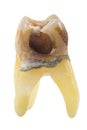 Extracted caries tooth