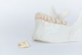 An extracted wisdom molar tooth ond jaw model