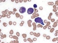 Extranodal NK T-cell lymphoma. Bone marrow cytology.
