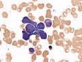 Extranodal NK T-cell lymphoma. Bone marrow cytology.