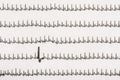 Extrasystole On Electrocardiogram