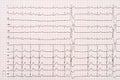 Extrasystole On 12 Lead Electrocardiogram Paper