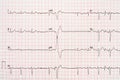 Extrasystole On 12 Lead Electrocardiogram Paper