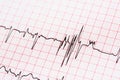 Extrasystoles On Electrocardiogram