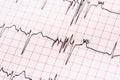 Extrasystoles On Electrocardiogram