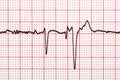 Extrasystoles On Electrocardiogram