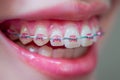 Extreme close-up of a mouth and orthodontic braces on the teeth