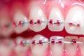 Extreme close-up of a mouth and orthodontic braces on the teeth