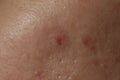 Texture of problematic human skin with large-looking open pores and acne scars