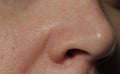 Texture of problematic human skin with large-looking open pores, acne scars and nasolabial fold Royalty Free Stock Photo