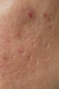 Texture of problematic human skin with large-looking open pores and acne scars