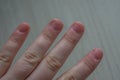 Extremely damaged finger nails with swollen cuticles from nail biting due to anxiety and compulsive disorder. Conceptual image