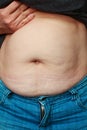 Extremely obese womans belly.